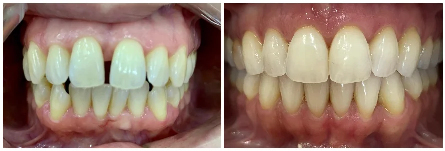Legenda: Antes e Depois do Tratamento de Diastema utilizando o Aparelho Invisalign. Legenda: Antes e Depois do Tratamento de Diastema utilizando o Aparelho Invisalign.