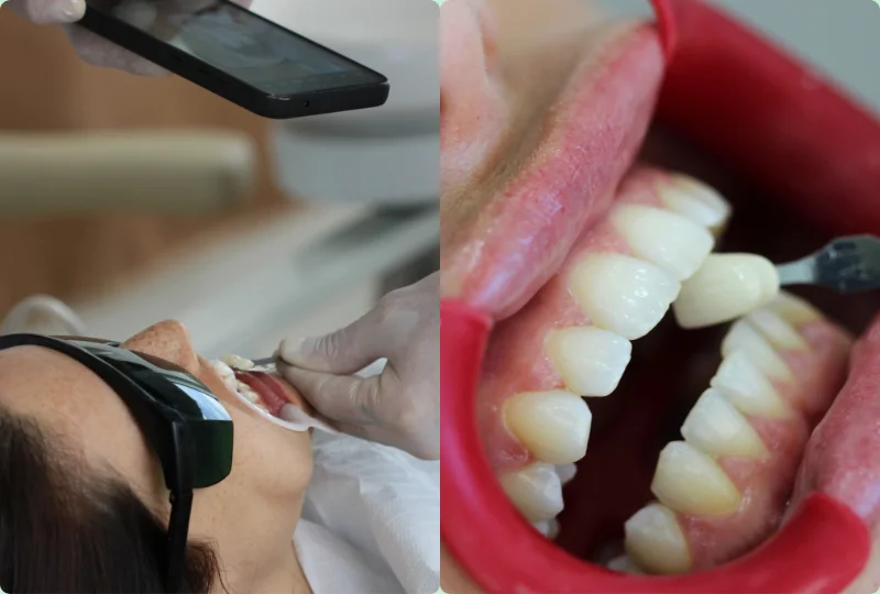 clareamento-dental-clinica-fontes-odontologia-ipanema-rj