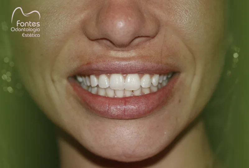 clareamento-dental-ipanema-rj-capa