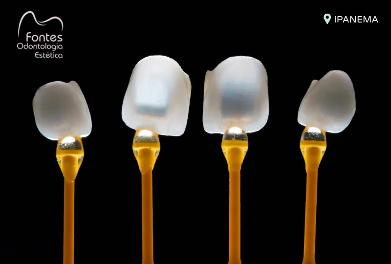 faceta dental fina porcelana