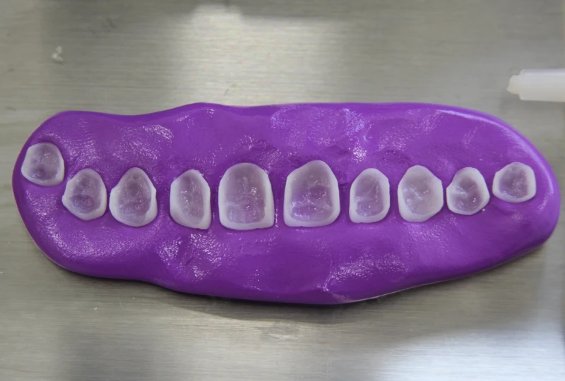 facetas ceramica finas espessura