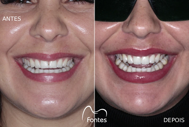 facetas resina antes depois paciente 001