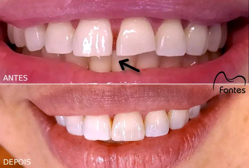 fechamento diastema lente dental paciente 001