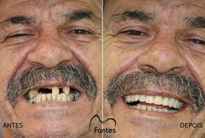 protese total reabilitacao oral antes depois paciente 001 b
