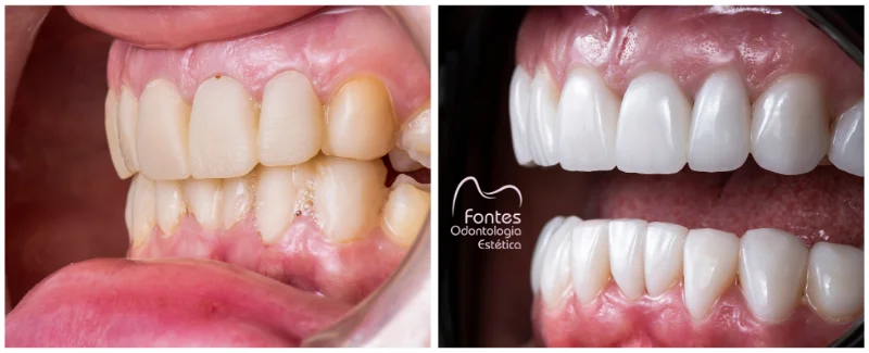 antes depois faceta porcelana 001