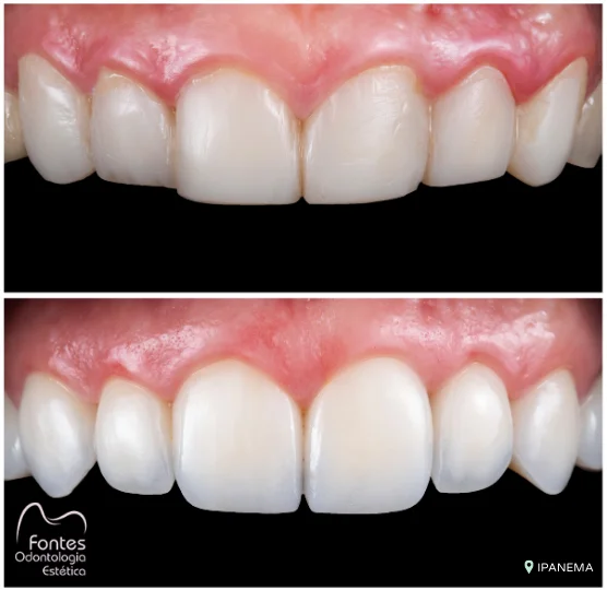 antes depois faceta resina 001