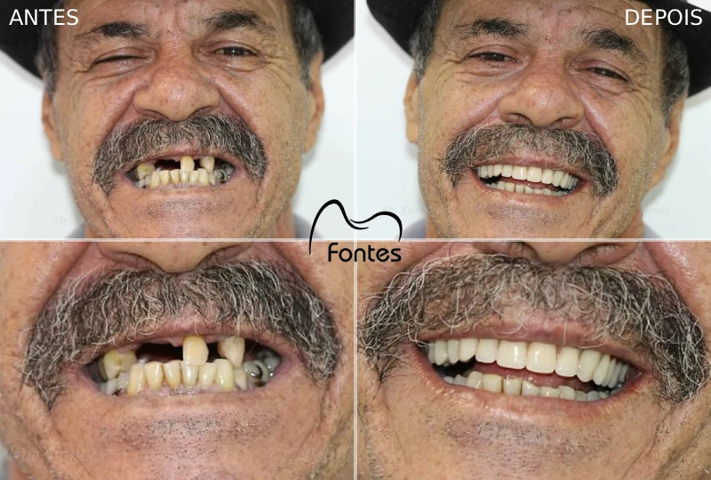 protese total reabilitacao oral antes depois paciente 001